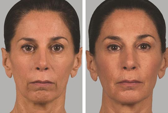 Before and after sculptra
